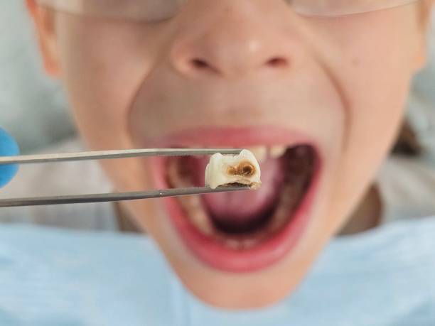 Best Emergency Treatment for Dental Infections or Abscesses in Glendale, CO